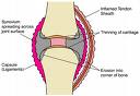 Rheumatoid arthritis: inflamed joints