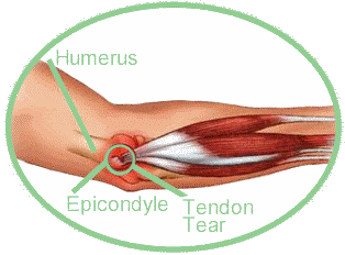 Tennis elbow